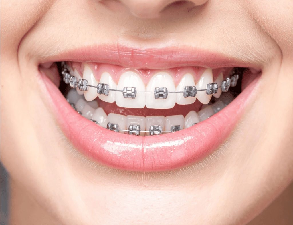 Braces Cost Guide